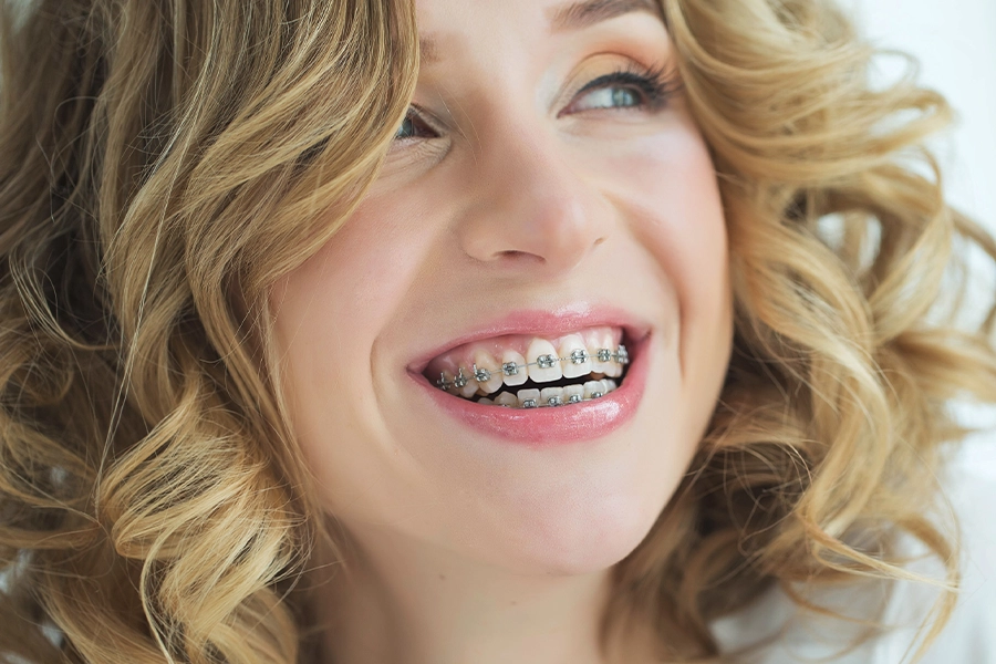 metal-braces